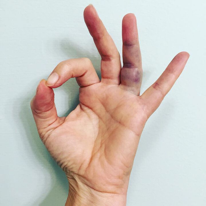 Признаци и симптоми на засрещнат пръст