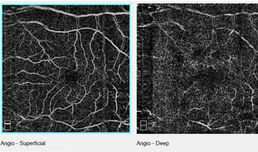 ОСТ-Ангиография- Безконтрастно изследване на съдовете на окото