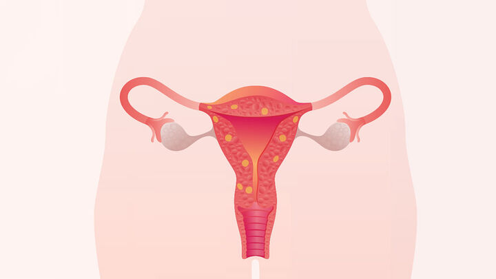 Жълто тяло и аденомиоза - важни фактори за репродуктивното здраве на жените