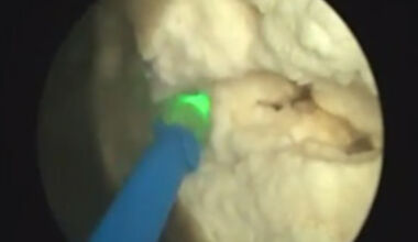 Лазерно разбиване на 10 см камък в пикочния мехур - видео