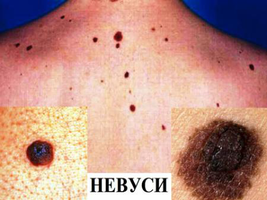 Преди да покажете бенките (невуси) на слънце, покажете ги на дерматолог!