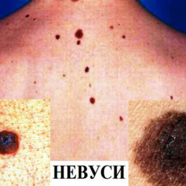 Преди да покажете бенките (невуси) на слънце, покажете ги на дерматолог!