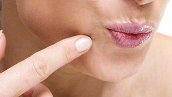 Ефективен метод за отстраняване на фиброми, папиломи