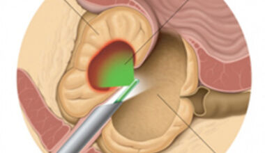 Коя е най-добрата операция за увеличена простата?