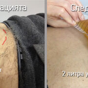 Над 2 литра задръжка на урината заради увеличена простата!