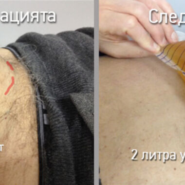 Над 2 литра задръжка на урината заради увеличена простата!