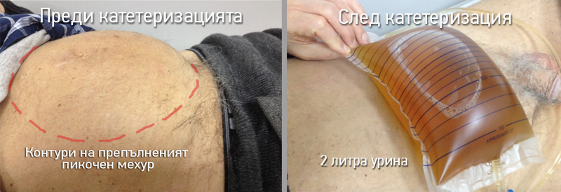 Nad 2 Litra Zadrzhka Na Urinata Zaradi Uvelichena Prostata Credoweb