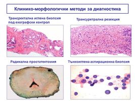 Патоморфологична характеристика на простатния карцинома (ПРЕЗЕНТАЦИЯ)