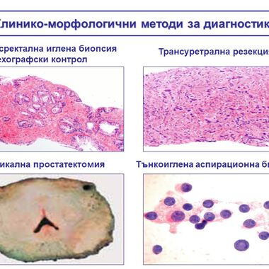 Патоморфологична характеристика на простатния карцинома (ПРЕЗЕНТАЦИЯ)