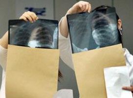 Само трима пациенти с активна туберкулоза след безплатния скрининг в УМБАЛ „Свети Георги“