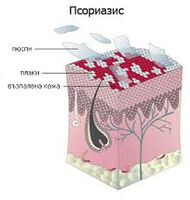 КАК ДА ЖИВЕЕМ С ПСОРИАЗИС?