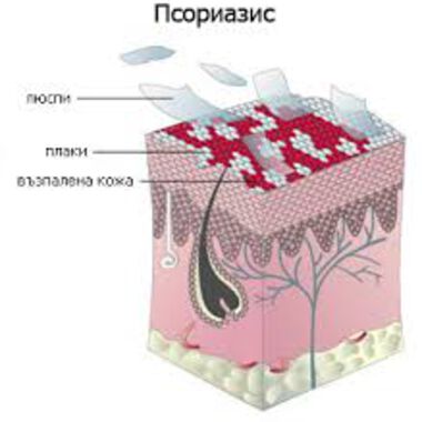 КАК ДА ЖИВЕЕМ С ПСОРИАЗИС?