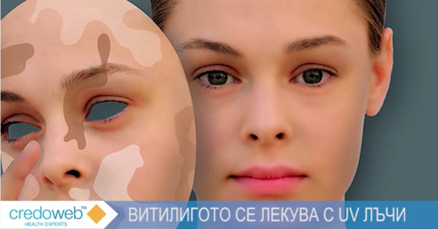 Витилигото се лекува с UV лъчи (ВИДЕО)
