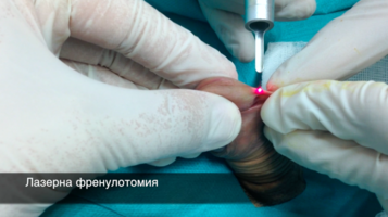 Предимствата на лазерна френулотомия