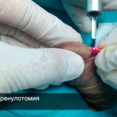 Предимствата на лазерна френулотомия