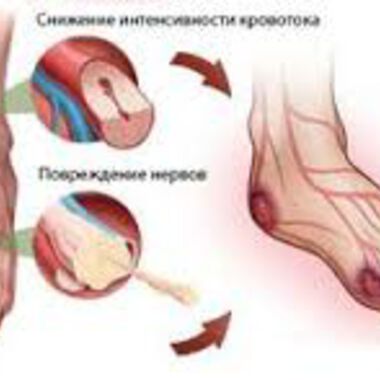 Всеки втори диабетик у нас с диабетна полиневропатия