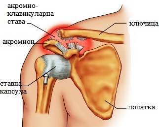 Остра тромбоза на a.axillaris след хабитуална луксация на раменна става (презентация)