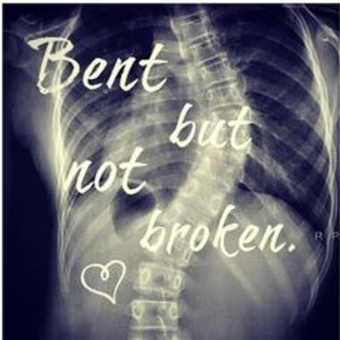 Идиопатична сколиоза (scoliosis idiopathica)