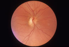 Хередитарна оптична невропатия (атрофия)  на Лебер