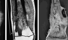 Osteosarcoma: factores que originan la enfermedad
