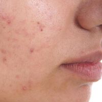 Acne medications - the role of the physician in patient perceptions- analysis