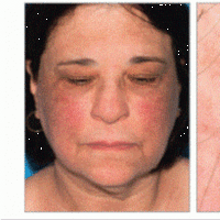 Gray-brown patches on the face of a 62-year-old woman - a clinical presentation