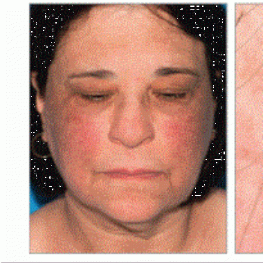 Gray-brown patches on the face of a 62-year-old woman - a clinical presentation