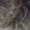 A Case of Woolly Hair with Dextrocardia and Situs Inversus