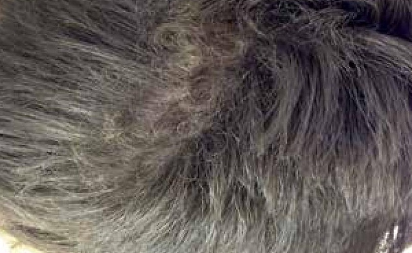 A Case of Woolly Hair with Dextrocardia and Situs Inversus