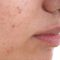 Acne can be more distressing than melanoma