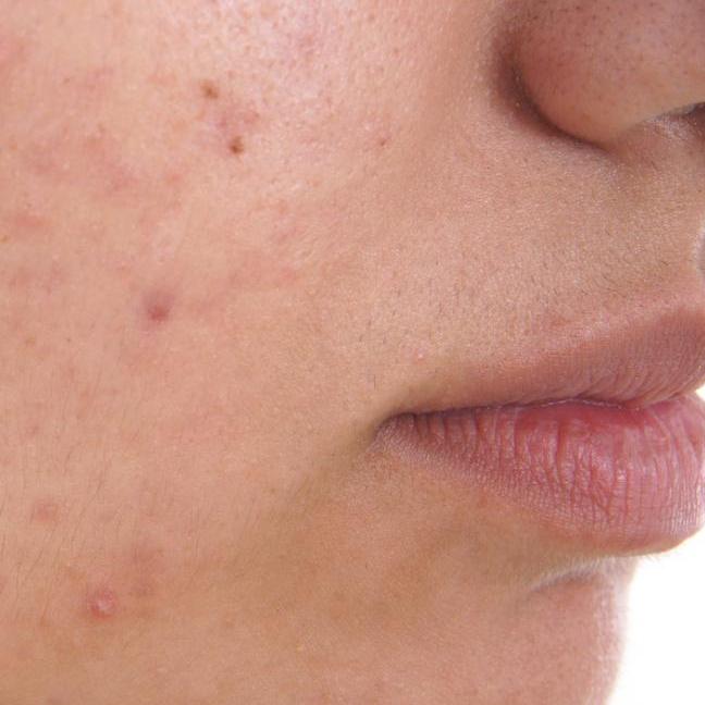 Acne can be more distressing than melanoma