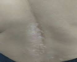 Lumbar vitiligo