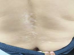 Lumbosacral vitiligo