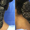 A disfiguring mass on the posterior aspect of the neck