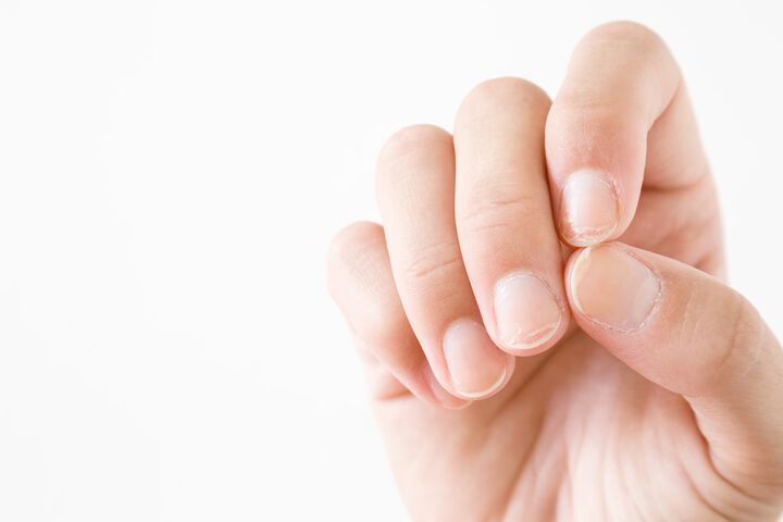 5 tips to improve nail psoriasis at home
