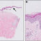 Recurrent Attack of Metformin Induced Bullous Pemphigoid