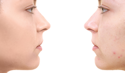 Chemical Peels for Post Acne Hyperpigmentation in Skin of Color