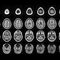 Portable MRI brings brain imaging to the patient bedside