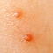 Molluscum contagiosum - how to stop spreading it?