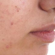Evaluation of adolescents diagnosed with acne vulgaris for psychosocial challenges