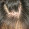 6 domains should be measured in psoriasis clinical trials, study finds