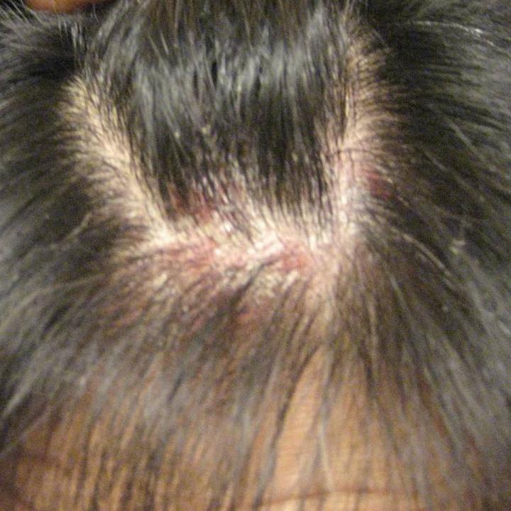 6 domains should be measured in psoriasis clinical trials