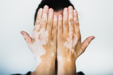 A study of autologous epidermal non-cultured cell suspension in stable vitiligo patients