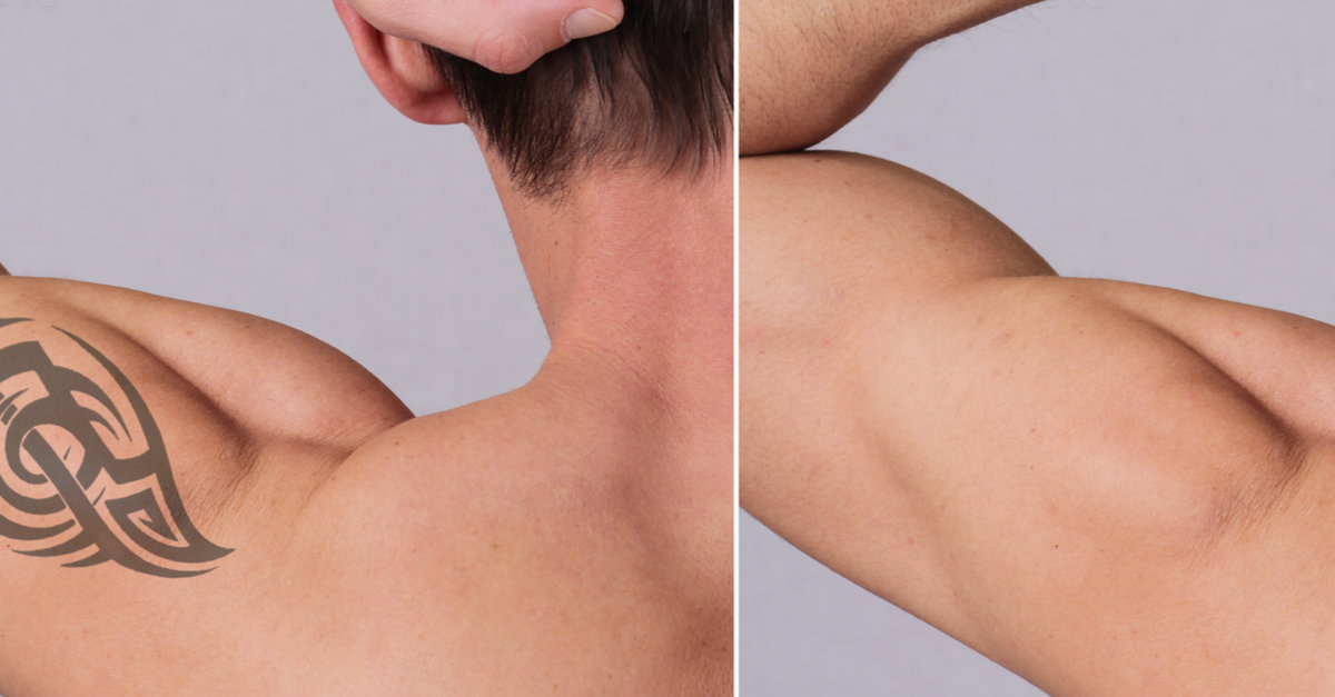 How to care for your skin after tattoo removal
