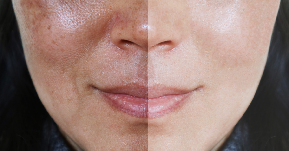 Correlation of Estradiol and Estriol Serum Levels to Melasma Severity in Pregnant Women