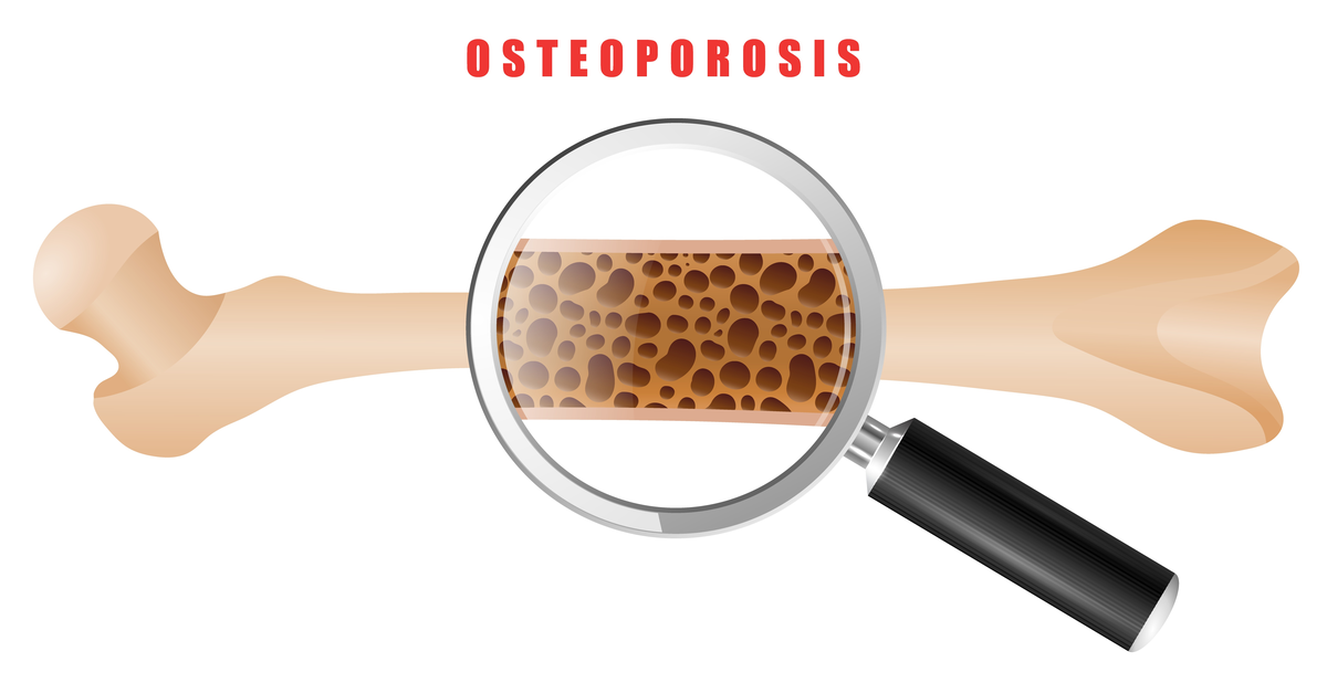 More than two sodas per day - higher risk of hip fracture in menopause