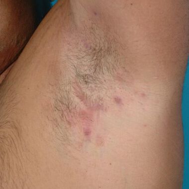 Association of Hidradenitis Suppurativa With Body Image