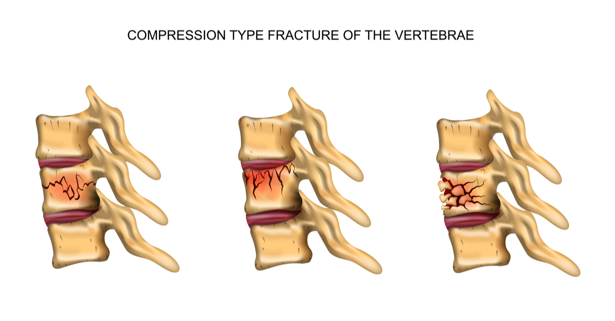 Type 2 diabetes associated with 35% higher risk for spinal fractures