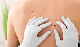 MELANOMA clinical guideline