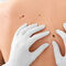 MELANOMA clinical guideline